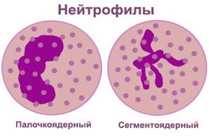 Neutrophilia: symptoms and treatment