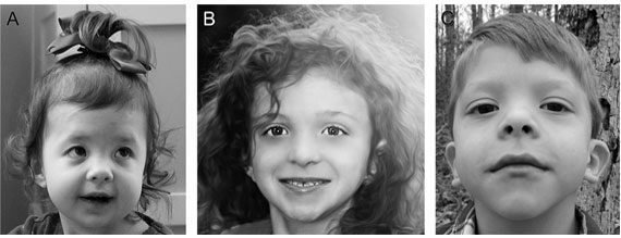 Noonan syndrome, how to treat?