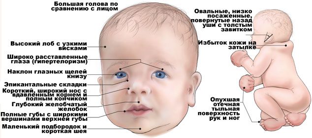 Noonan syndrome, how to treat?