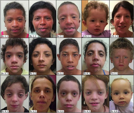 Noonan syndrome, how to treat?