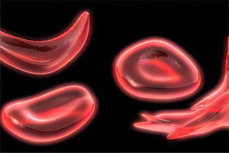 Normocytic (normochromic) anemia