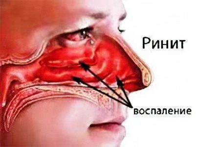 Nose pain: causes and treatment