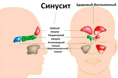 Nose pain: causes and treatment