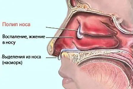 Nose pain: causes and treatment