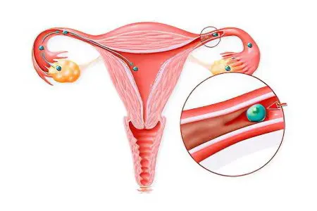 Obstruction of the fallopian tubes, what to do