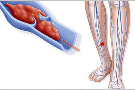 Occlusive thrombosis