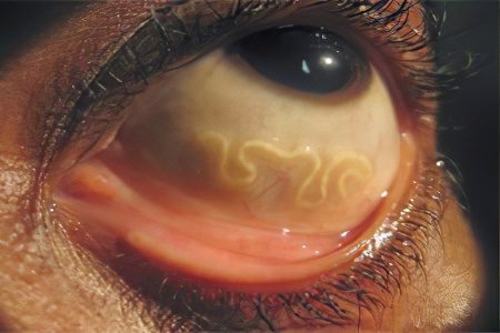 Toxocariasi oculare