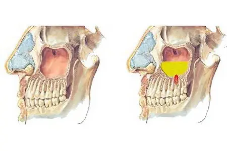 Odontogenic sinusitis