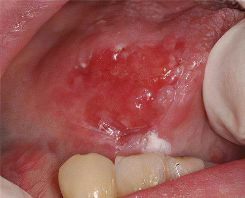 Oral leukoplakia: symptoms and treatment