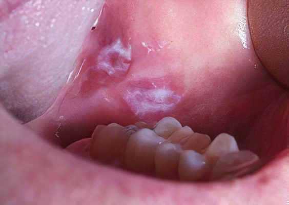 Oral leukoplakia: symptoms and treatment