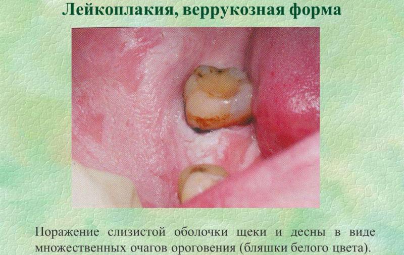 Oral leukoplakia: symptoms and treatment