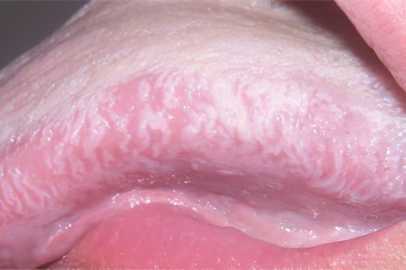 Oral leukoplakia: symptoms and treatment