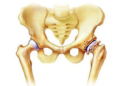 Osteoarthritis of the hip joint