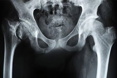 Osteoarthritis of the hip joint