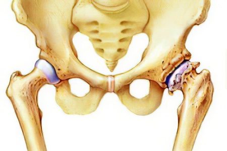 Osteoarthritis of the hip joint