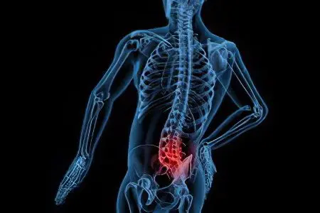 Osteochondrosis of the lumbosacral spine