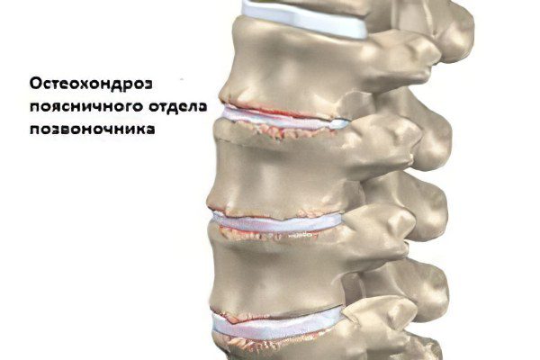 Osteochondrosis of the lumbosacral spine