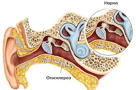 Otosclerosis: symptoms and treatments