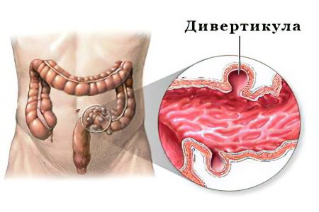 Pain in left side, lower abdomen