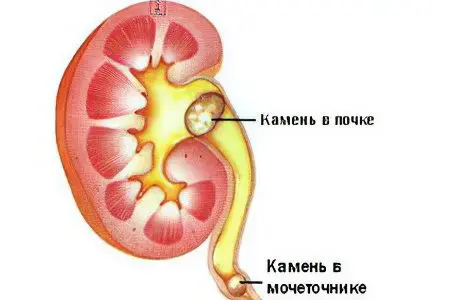 Pain in right side, lower abdomen