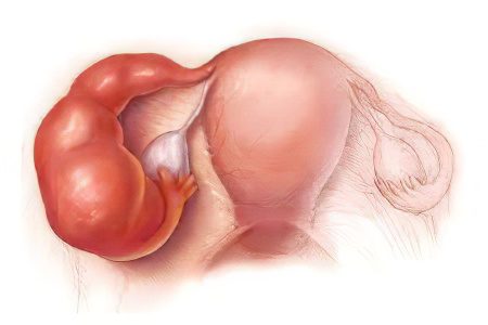 Pain in right side, lower abdomen