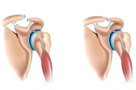 Pain in the forearm: how to treat?