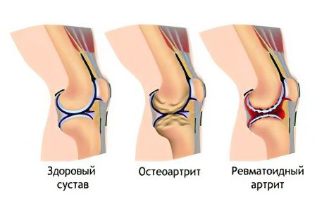 Pain in the knee joint