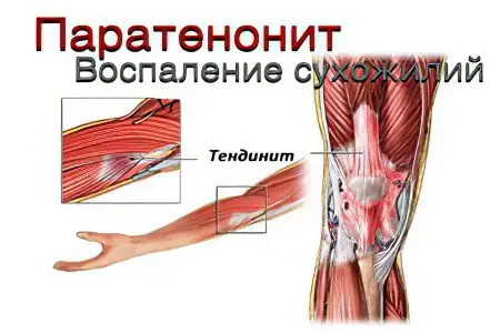 Pain in the muscles of the legs: what to do?