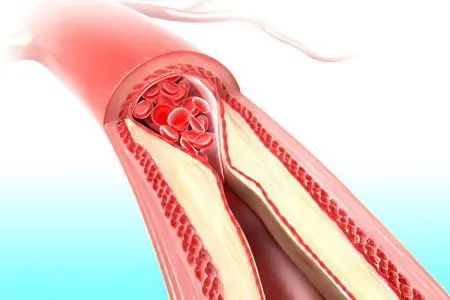 Pain in the muscles of the legs: what to do?