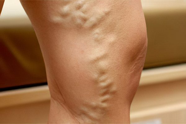 Pain in the muscles of the legs: what to do?