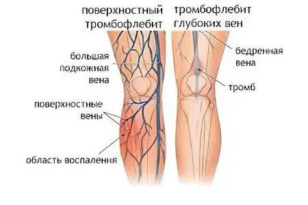 Pain in the muscles of the legs: what to do?