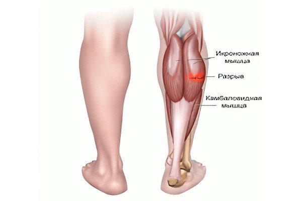 Pain in the muscles of the legs: what to do?