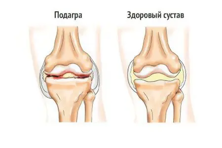 Pain in the muscles of the legs: what to do?