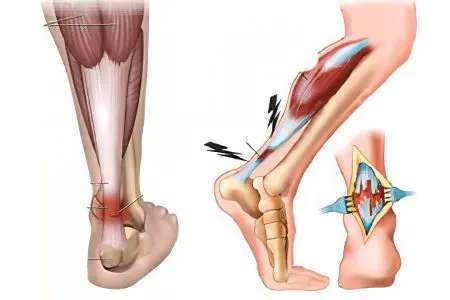 Pain in the muscles of the legs: what to do?