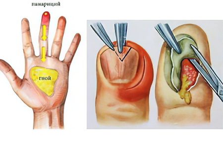 Panaritium: causes, symptoms and treatment