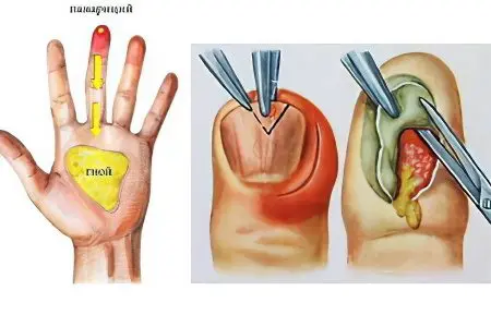 Panaritium: causes, symptoms and treatment