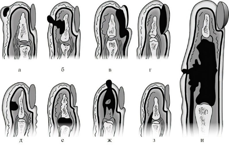 Panaritium: causes, symptoms and treatment