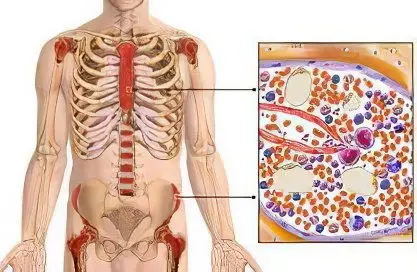 Pancytopenia: causes, symptoms and treatment