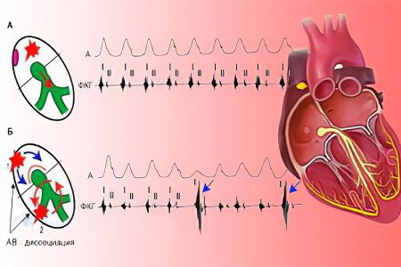 Paroxysmal tachycardia