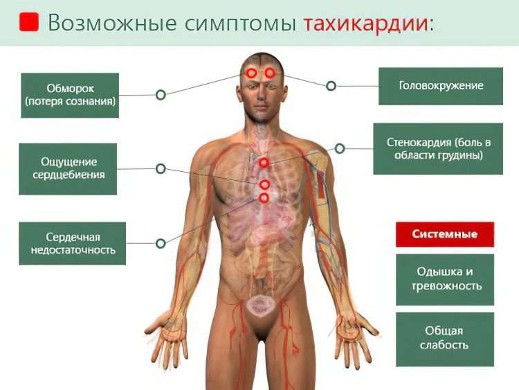 Paroxysmal tachycardia