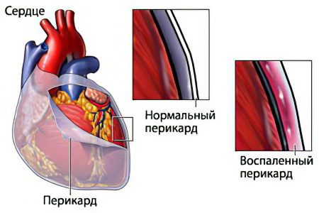 Pericarditis: what is it? Symptoms and treatment