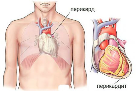 Pericarditis: what is it? Symptoms and treatment