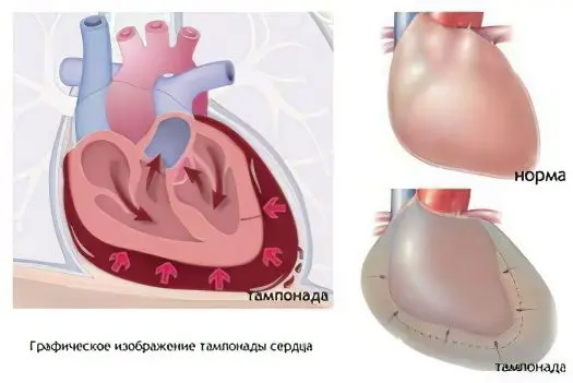 Pericarditis: what is it? Symptoms and treatment