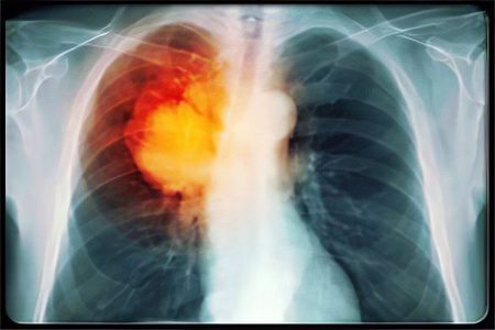 Peripheral lung cancer