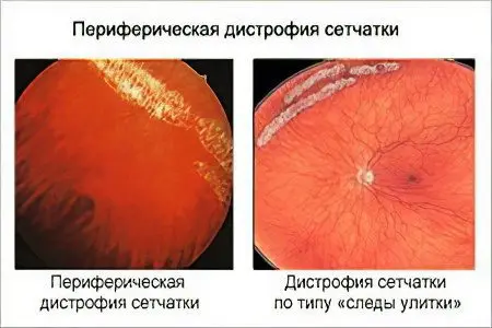 Peripheral retinal dystrophy