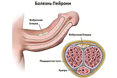 Peyronie&#8217;s disease in men