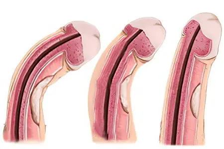 Peyronies disease in men