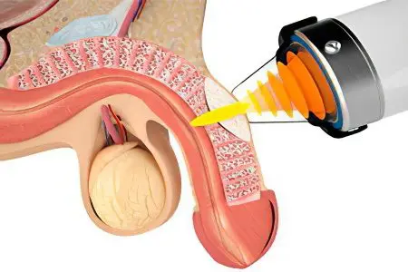 Peyronies disease in men