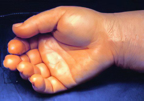 Phlegmon of the hand, varieties of the disease