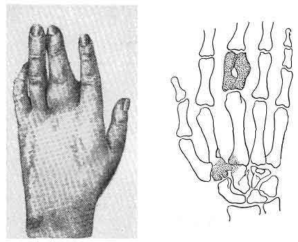 Phlegmon of the hand, varieties of the disease